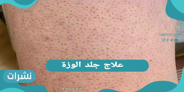 علاج جلد الوزة.. الأسباب وطرق العلاج