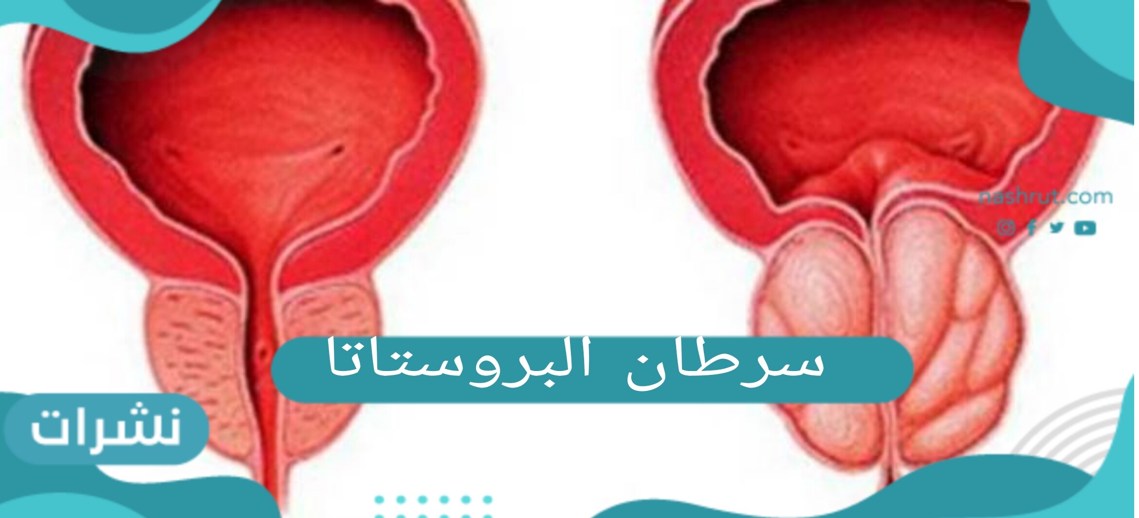 سرطان البروستاتا