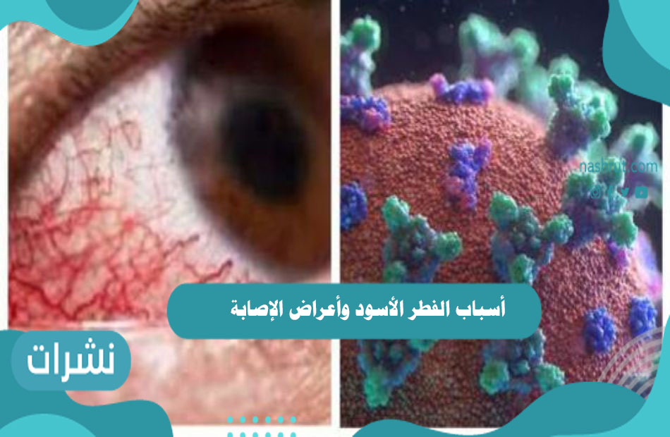 أسباب الفطر الأسود وأعراض الإصابة