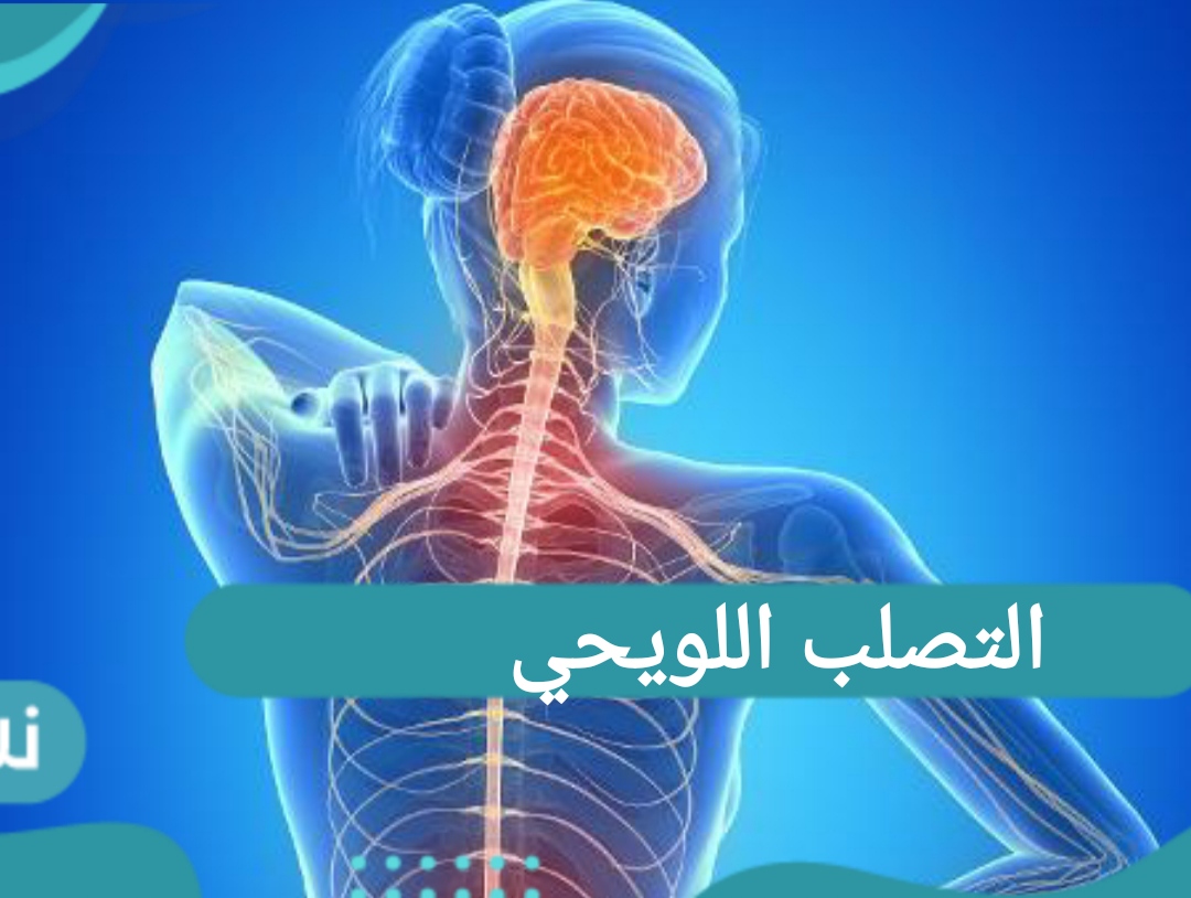 التصلب اللويحي
