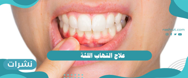 علاج التهاب اللثة