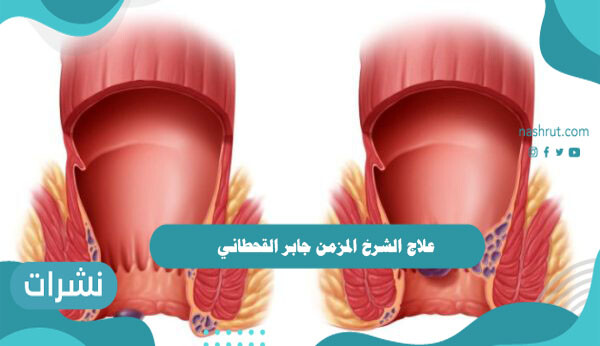علاج الشرخ المزمن جابر القحطاني