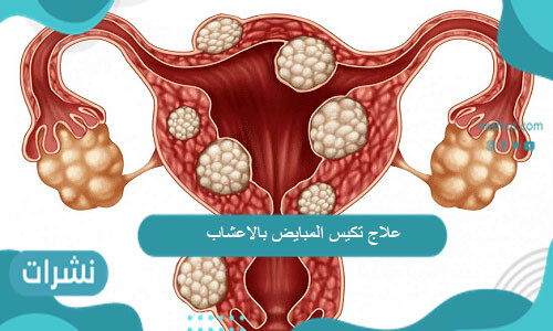 علاج تكيس المبايض بالاعشاب للدكتور جابر القحطاني