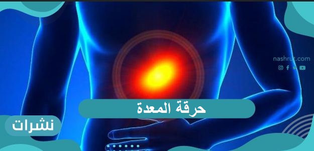 حرقة المعدة .. ما أسبابها وبعض الطرق الطبيعية للتغلب عليها نهائياً