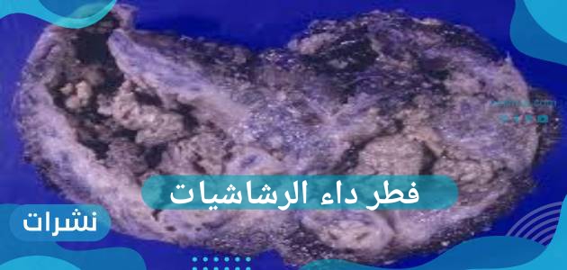 فطر داء الرشاشيات ينتشر في الهند بعد إنتشار الفطر الأسود