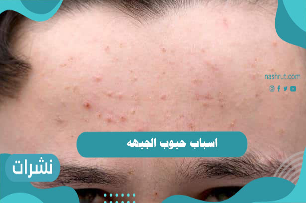 اسباب حبوب الجبهه وأفضل طرق منزلية لعلاجها