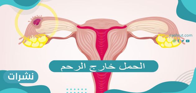 الحمل خارج الرحم