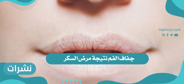 جفاف الفم ومرض السكر