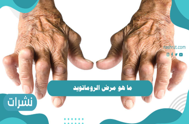 ما هو مرض الروماتويد