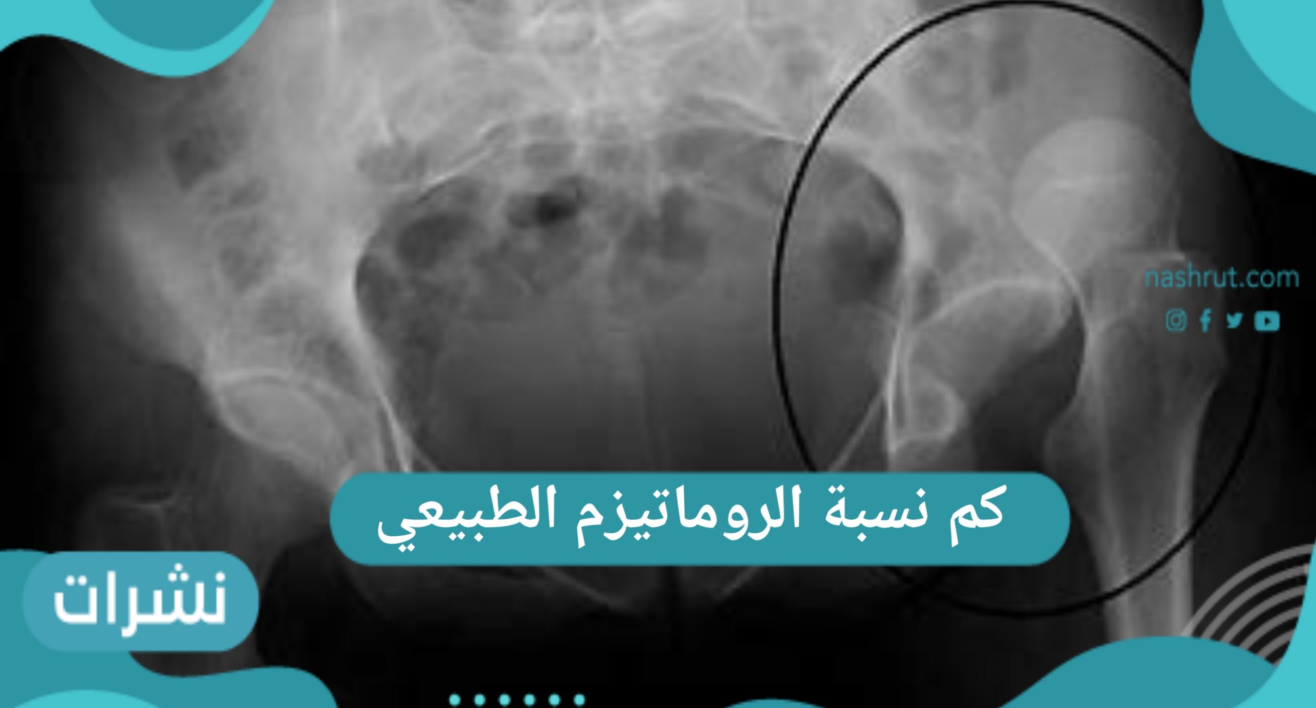 كم نسبة الروماتيزم الطبيعي في جسم الإنسان