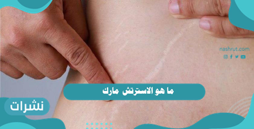 ما هو الاسترتش مارك واسباب ظهورها