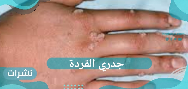 جدري القردة.. مرض جديد يغزو العالم فما هي طريقة انتقالة وأهم أعراضه وطريقة الوقاية